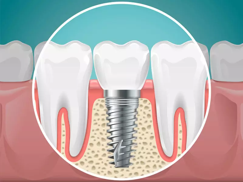 Featured image for “Do I Need A Temporary Prosthesis After My Full Mouth Dental Implants Are Placed?”