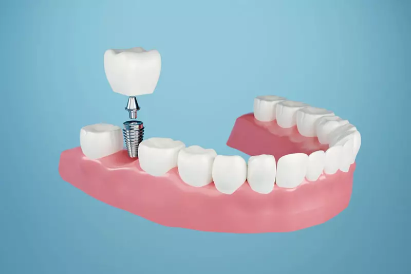 Featured image for “Are There Factors That Determine Which Type Of Dental Implant Procedure I Will Need To Restore My Smile?”