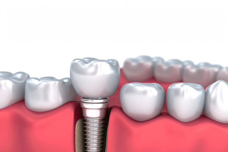 Featured image for “Should I Get Treated With Dental Implants After Tooth Extractions?”