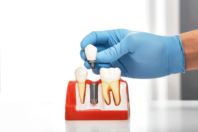 Featured image for “Is There A Way To Avoid Peri-Implantitis After A Dental Implant Surgery?”