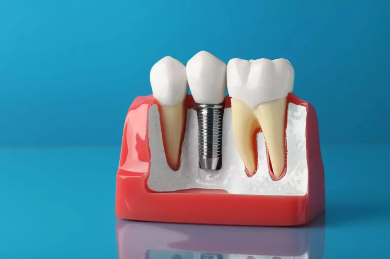 Featured image for “What Complications Can Occur With Dental Implant Placements?”