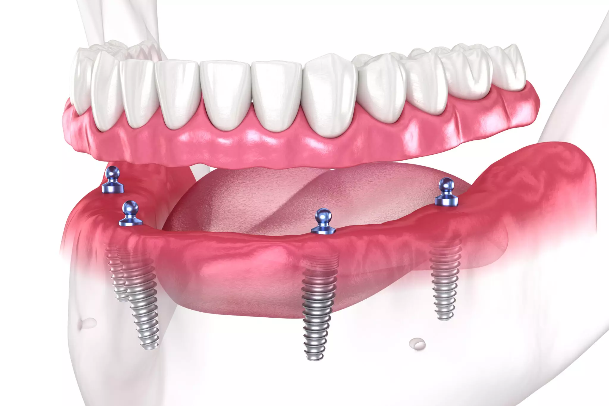 Featured image for “Is There A Difference Between A Temporary Prosthesis And A Final Prosthesis?”