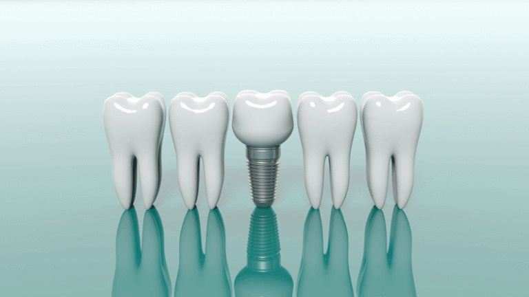 Featured image for “Do I Need A Full Mouth Dental Implant Consultation?”