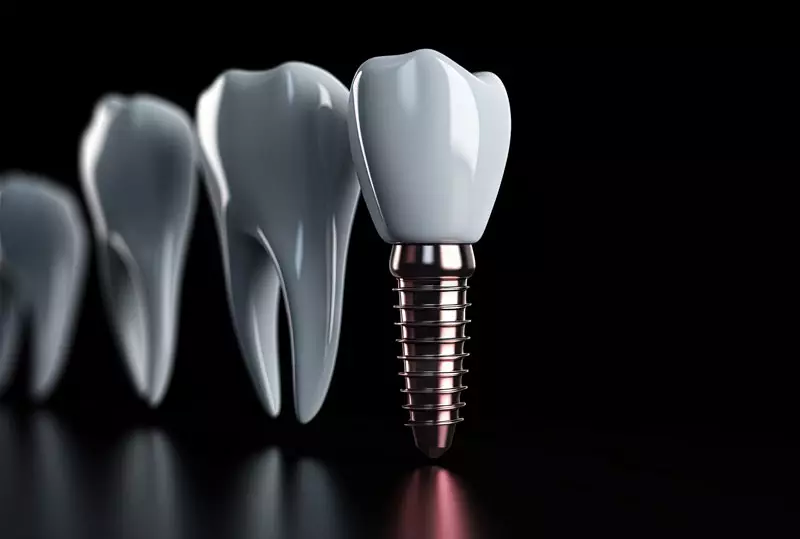 Featured image for “Are There Risks To Getting Treated With Dental Implants?”