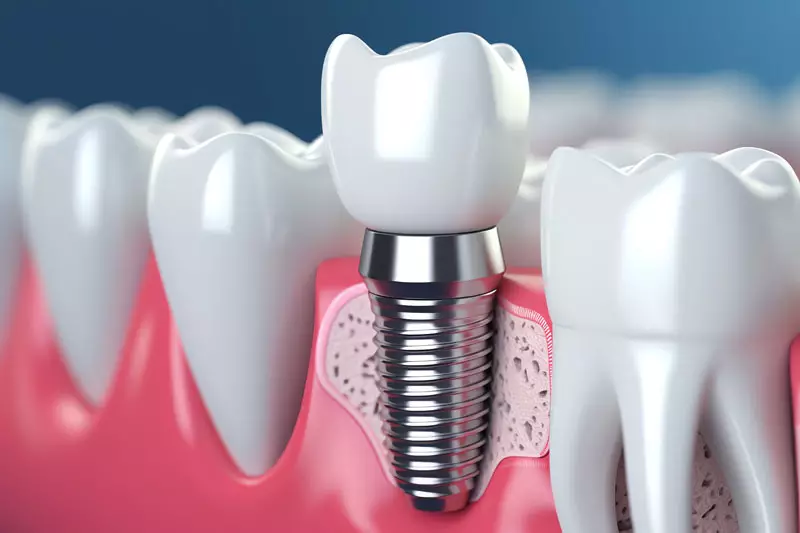 Featured image for “What Does The Dental Implant Post Part Of A Dental Implant Do?”