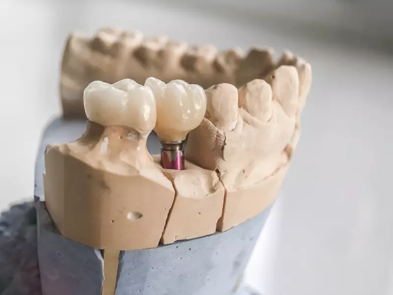 Featured image for “Are There Factors That Determine Which Type Of Dental Implant Procedure I Can Get Treated With?”