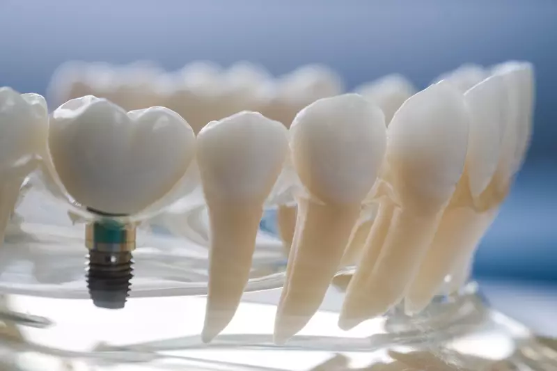 Featured image for “After My Dental Implants Are Placed, How Will I Know If I Have Peri-Implantitis?”